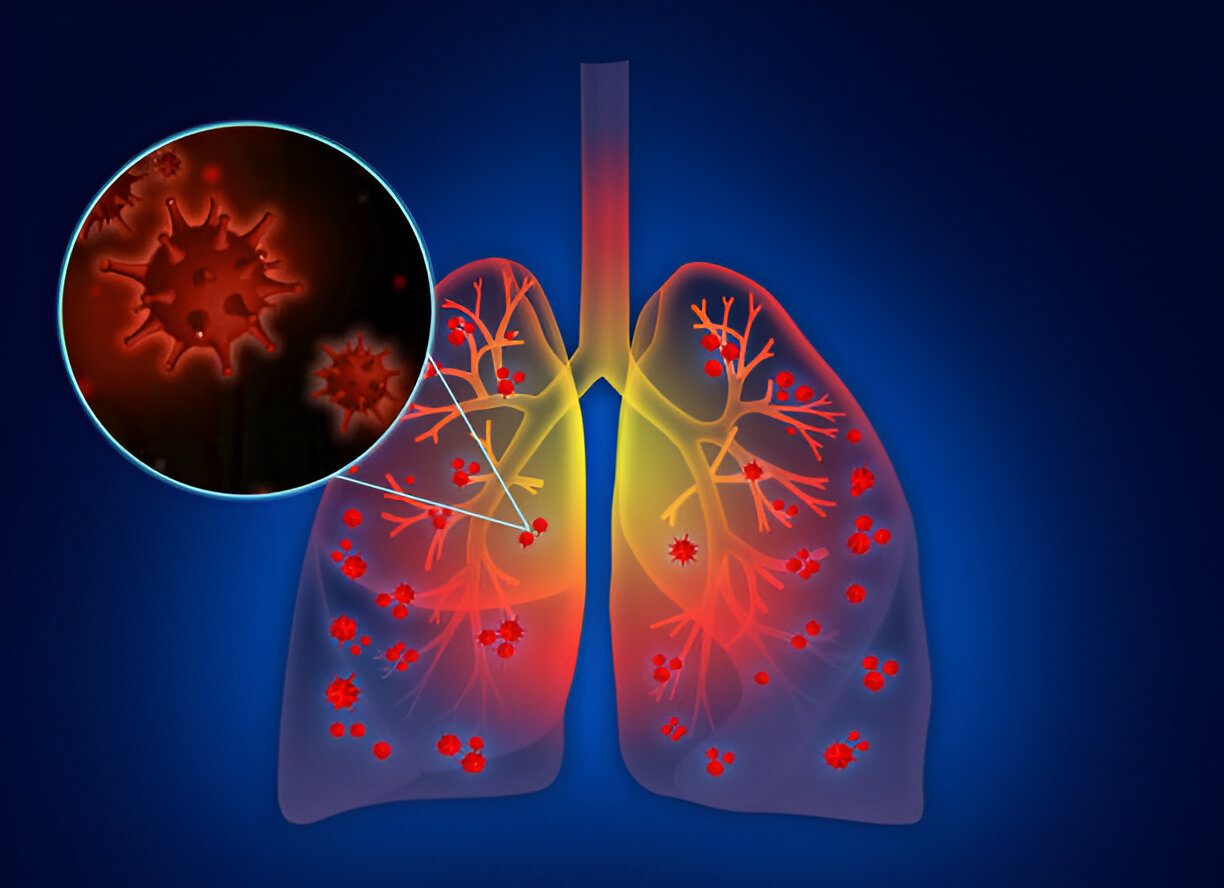 Pneumonia / Respiratory Infections